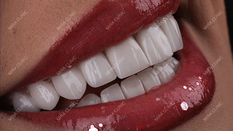 Hollywood Smile